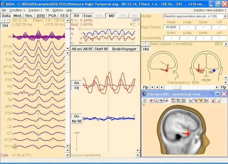 Screenshot of BESA software interface showing EEG source analysis for seizure onset in the right temporal lobe, with waveform plots, modeled dipole source location, and anatomical MRI overlay highlighting seizure focus